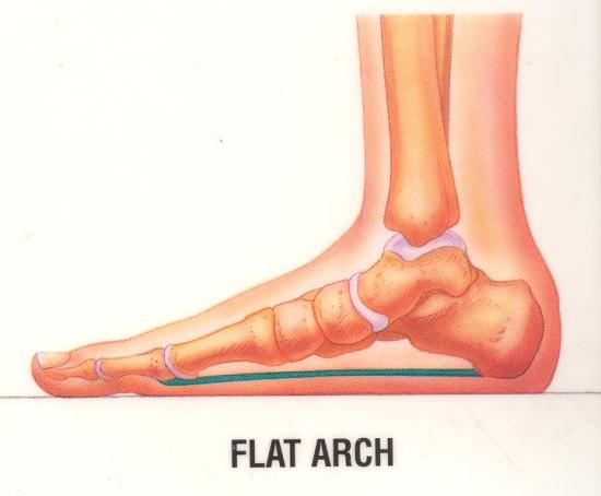 Flat Foot